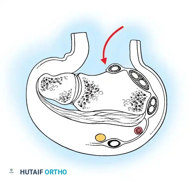 FRACTURES OF THE DISTAL RADIUS Surgical Diagram
