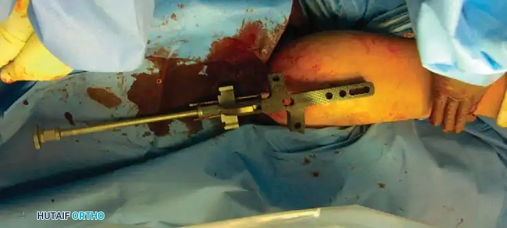 الدليل الشامل لعلاج كسور عظمة العضد الخيارات الجراحية والتحفظية