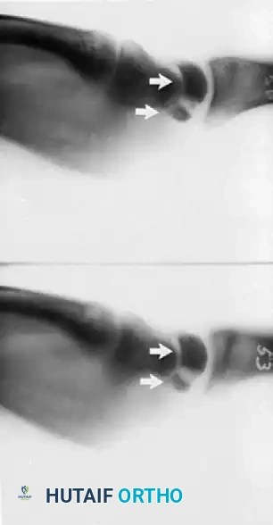 FRACTURES OF THE LUNATE AND KIENBÖCK DISEASE Surgical Diagram
