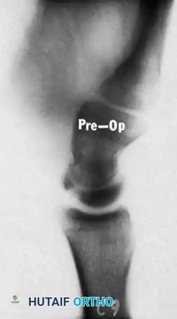 Lunate healed (12 mo)