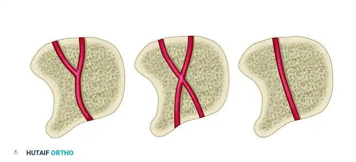 FIGURE 69-52 A, Common fracture pattern in Kienböck disease is so-called anterior pole type, isolating anterior pole of lunate from remaining portion of bone. Distraction of fracture caused by compressive force exerted by capitate diminishes likelihood of fracture healing. This detail usually is invisible on routine radio graphs because radial styloid process is superimposed on fracture gap. As dorsal portion of lunate collapses further, anterior pole may be extruded volarly. B, Ratio of height of carpus to length of third metacarpal is reduced in this patient with Kienböck disease. This ratio in normal wrists has been reported to be 0.54 ± 0.03, and significantly reduced ratios indicate overall carpal collapse.