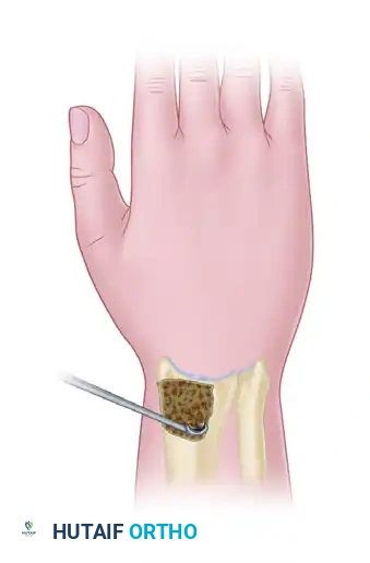 FRACTURES OF THE LUNATE AND KIENBÖCK DISEASE Surgical Diagram