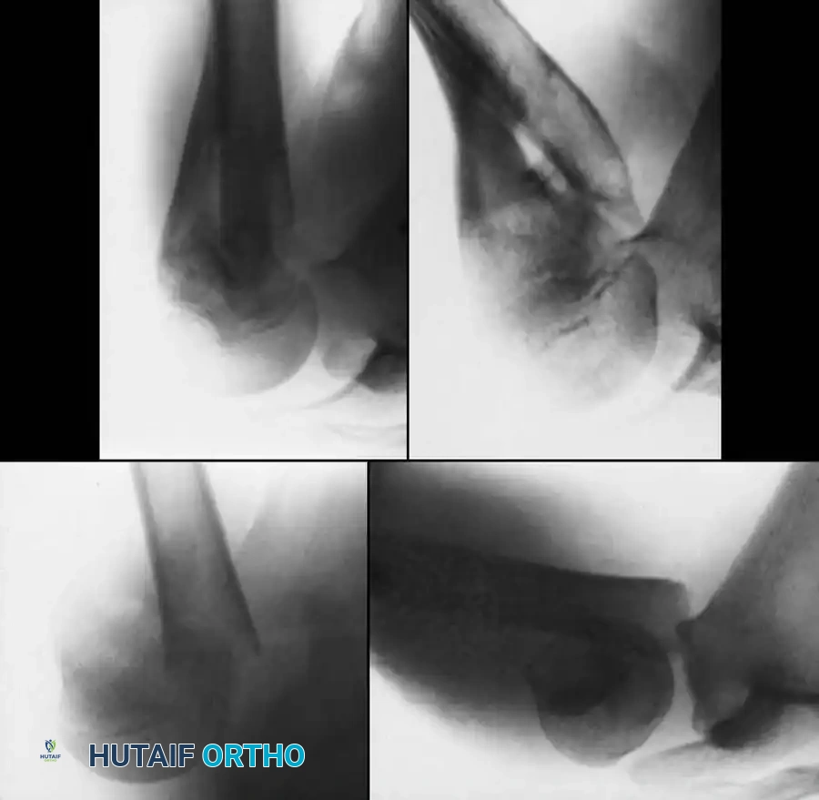 Pediatric Fractures of the Humeral Shaft and Proximal Physis: A Comprehensive Surgical Guide