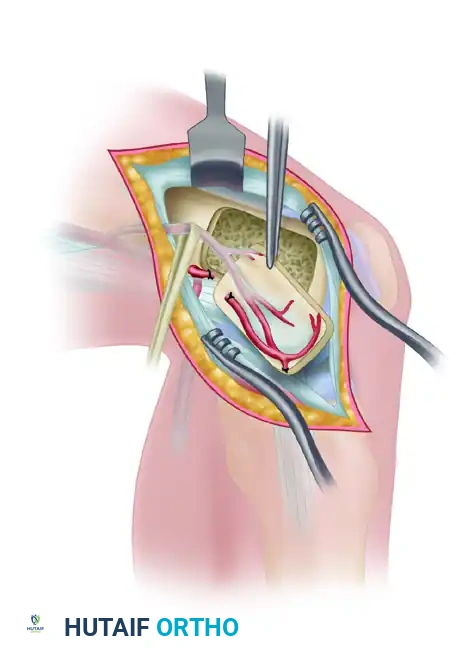 FREE ILIAC CREST BONE GRAFT Surgical Diagram