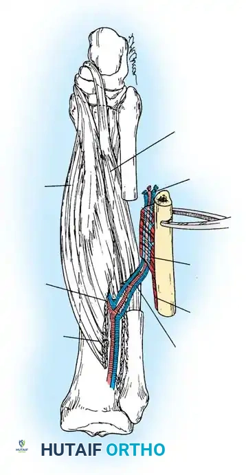 FREE VASCULARIZED BONE TRANSPLANT Surgical Diagram