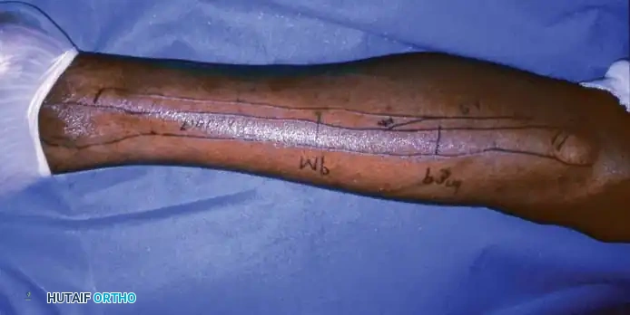 Graft Inset and Fixation