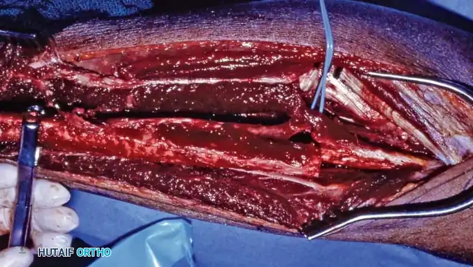 Intraoperative Osteotomy