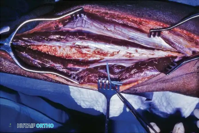 Postoperative Radiograph Fixation