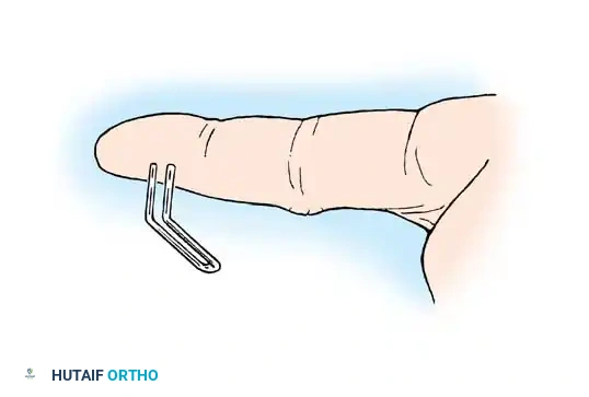 From MacKinnon SF, Dellon AL: Surgery of the peripheral nerve, New York, 1988, Thieme. Surgical Diagram