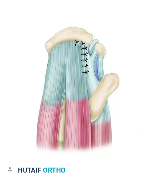 FULL-THICKNESS ROTATOR CUFF TEARS Surgical Diagram
