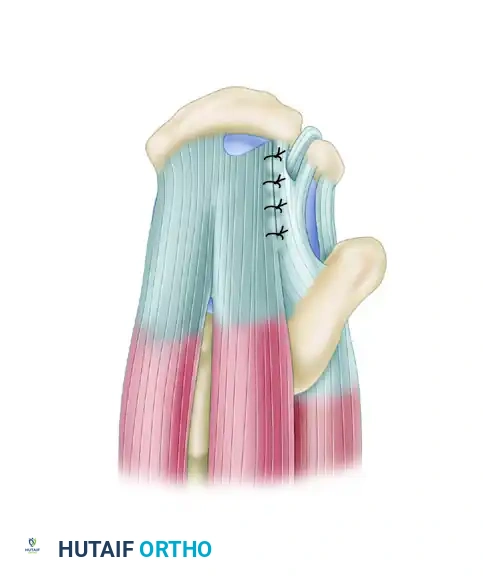 FULL-THICKNESS ROTATOR CUFF TEARS Surgical Diagram