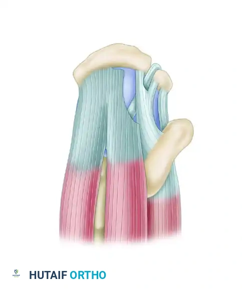 FULL-THICKNESS ROTATOR CUFF TEARS Surgical Diagram