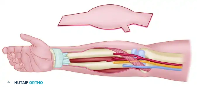 Functioning Free Neuromuscular Transfers: Principles and Surgical Techniques