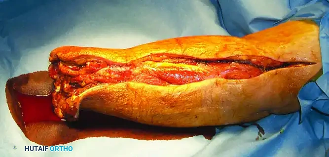 GAS GANGRENE Surgical Diagram