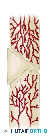 GENERAL TREATMENT OF NONUNIONS Surgical Diagram