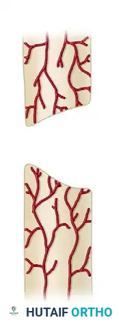 GENERAL TREATMENT OF NONUNIONS Surgical Diagram