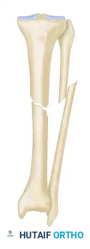 GENERAL TREATMENT OF NONUNIONS Surgical Diagram