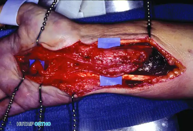 GIANT CELL TUMOR OF THE TENDON SHEATH (XANTHOMA) Surgical Diagram
