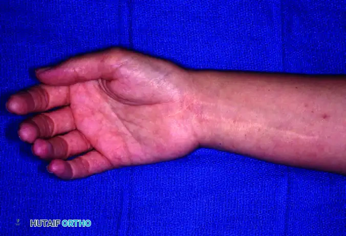 GIANT CELL TUMOR OF THE TENDON SHEATH (XANTHOMA) Surgical Diagram