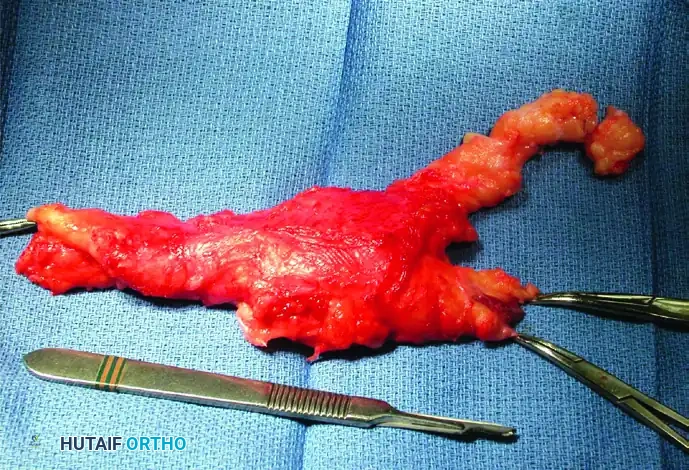 GIANT CELL TUMOR OF THE TENDON SHEATH (XANTHOMA) Surgical Diagram