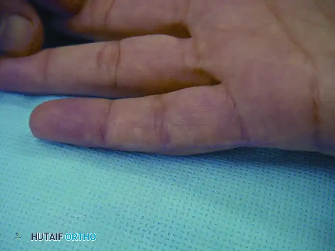 GIANT CELL TUMOR OF THE TENDON SHEATH (XANTHOMA) Surgical Diagram