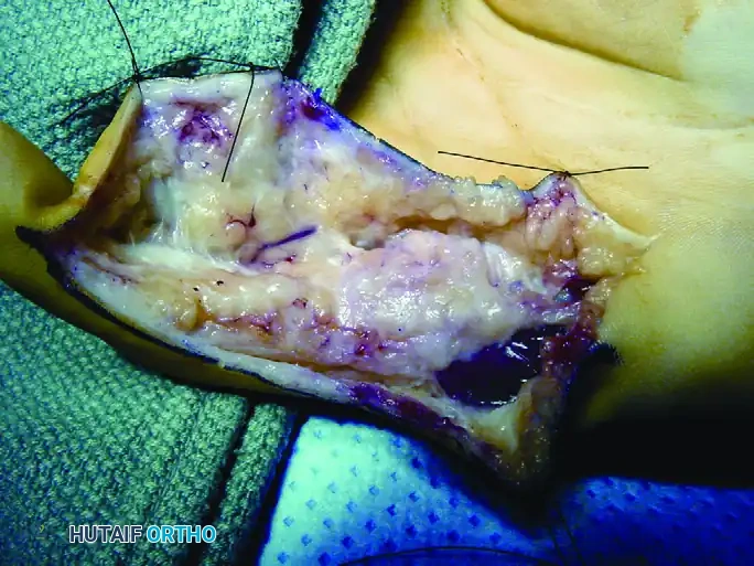 GIANT CELL TUMOR OF THE TENDON SHEATH (XANTHOMA) Surgical Diagram