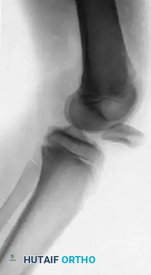 FIGURE 60-4 Knee dislocation. A, Lateral dislocation. B, Anterior dislocation.