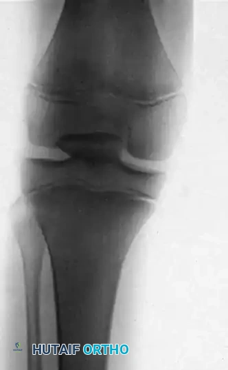 FIGURE 60-4 Knee dislocation. A, Lateral dislocation. B, Anterior dislocation.
