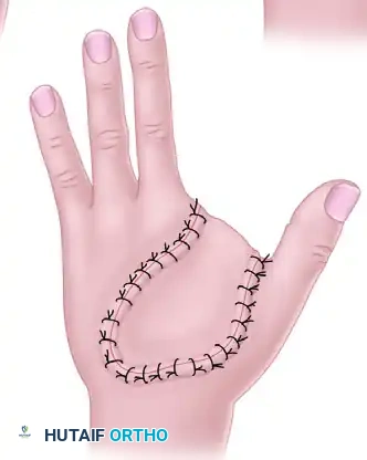 GRAFTS AND FLAPS Surgical Diagram