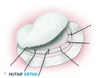 GRAFTS AND FLAPS Surgical Diagram