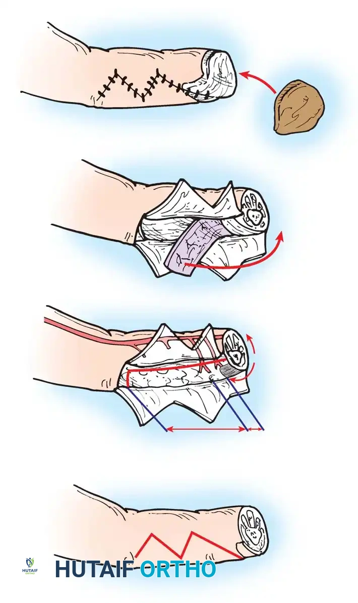 Orthopaedic Skin Grafts & Flaps: Surgical Techniques