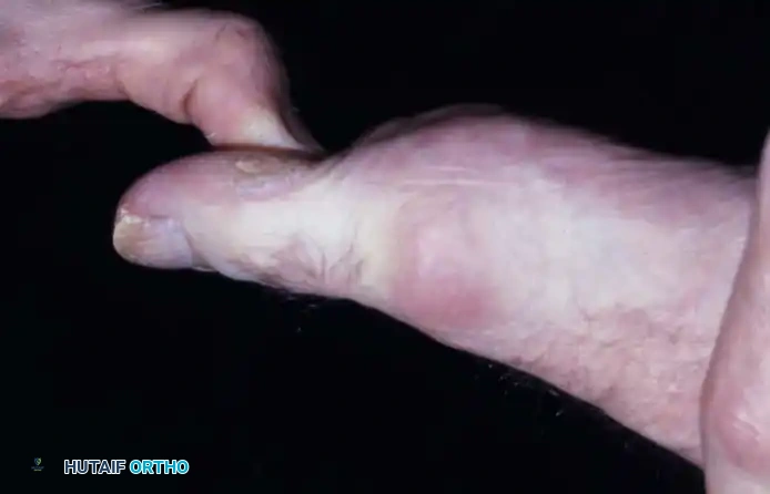 Fig. 78-85 Hallux rigidus. A, Marked limitation of metatarsophalangeal extension. B and C, Dorsal osteophyte and degenerative changes. D, Increased extension after joint débridement.