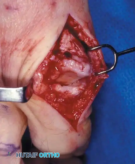 Fig. 78-85 Hallux rigidus. A, Marked limitation of metatarsophalangeal extension. B and C, Dorsal osteophyte and degenerative changes. D, Increased extension after joint débridement.