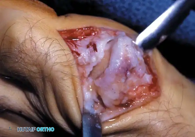 Fig. 78-85 Hallux rigidus. A, Marked limitation of metatarsophalangeal extension. B and C, Dorsal osteophyte and degenerative changes. D, Increased extension after joint débridement.