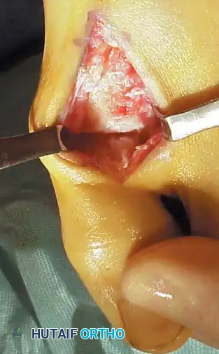 Cheilectomy Surgical Step