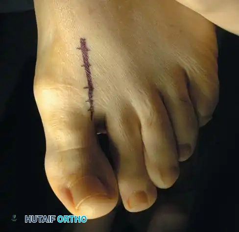 Fig. 78-91 Cheilectomy. A, Patient with stage II (radiographically) hallux rigidus; note dorsal osteophyte over fi rst metatarsal. B, Incision is placed at lateral border of extensor hallucis longus. C, Dorsal sensory nerve to hallux is protected. D, First metatarsophalangeal joint is exposed. E, Dorsal osteophytes are removed