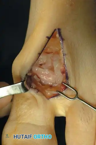 Fig. 78-91 Cheilectomy. A, Patient with stage II (radiographically) hallux rigidus; note dorsal osteophyte over fi rst metatarsal. B, Incision is placed at lateral border of extensor hallucis longus. C, Dorsal sensory nerve to hallux is protected. D, First metatarsophalangeal joint is exposed. E, Dorsal osteophytes are removed