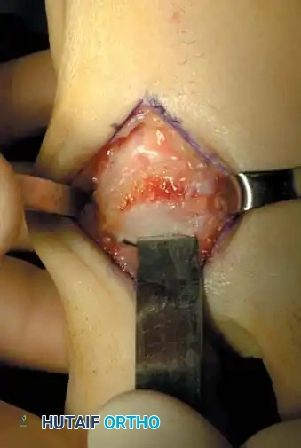 Cheilectomy Surgical Step