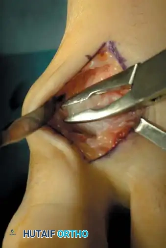 Cheilectomy Surgical Step