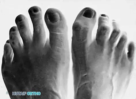 HAMMER TOE AND CLAW TOE Surgical Diagram