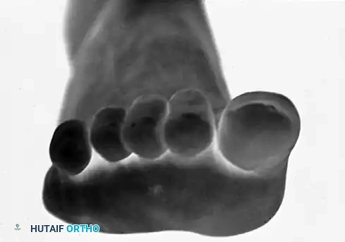 HAMMER TOE AND CLAW TOE Surgical Diagram