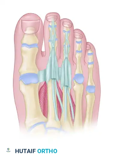 FIGURE 83-14 Site of tenderness with interdigital neuroma of second web space (A). Site of tenderness in idiopathic synovitis of second metatarsophalangeal joint: dorsofibular capsule and fibular collateral ligament (B).