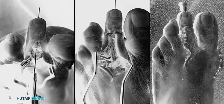 الدليل الشامل لعلاج إصبع القدم المطرقي والمخلبي