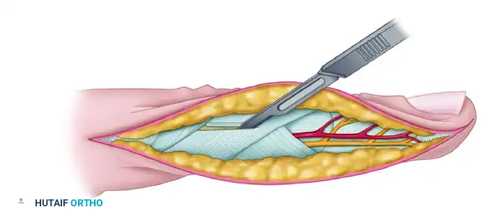 HAND FASCIOTOMIES Surgical Diagram
