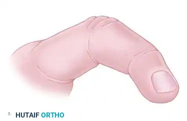 HAND FASCIOTOMIES Surgical Diagram