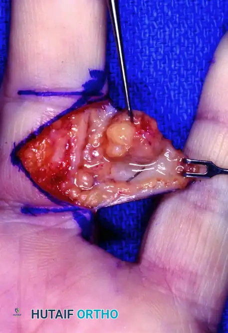 HEMANGIOMA Surgical Diagram