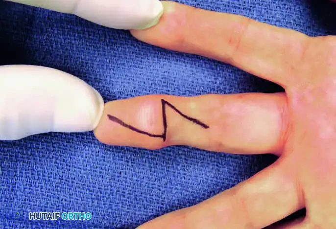 HEMANGIOMA Surgical Diagram