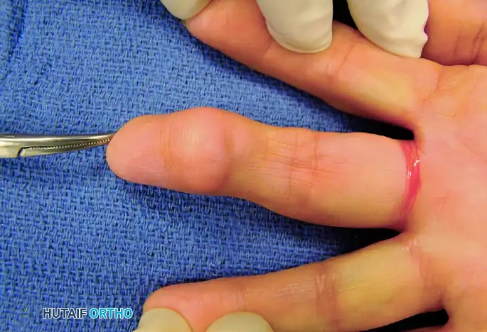 HEMANGIOMA Surgical Diagram
