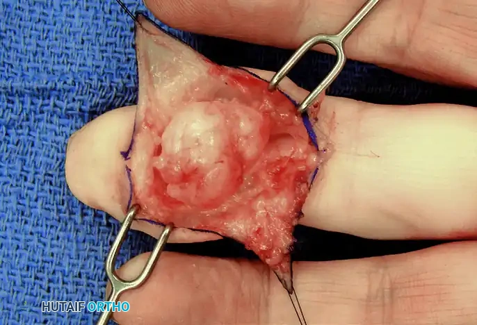 HEMANGIOMA Surgical Diagram