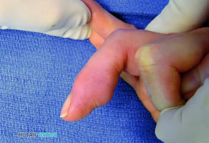 HEMANGIOMA Surgical Diagram